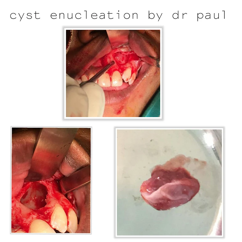 Cyst Tumor